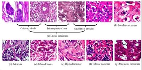 Histological Images Of A Variety Of Classes Of Breast Cancer Variety