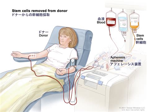 図は患者またはドナーから幹細胞を採取しているところを示している。腕の静脈から血液を体外に出して流し、幹細胞を採取する装置を通過させる。残りの