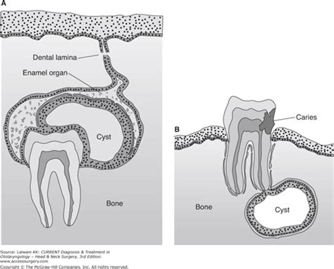 Different Types Of Dental Cysts Explained