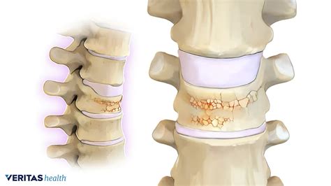 Osteoporosis Fracture Recovery
