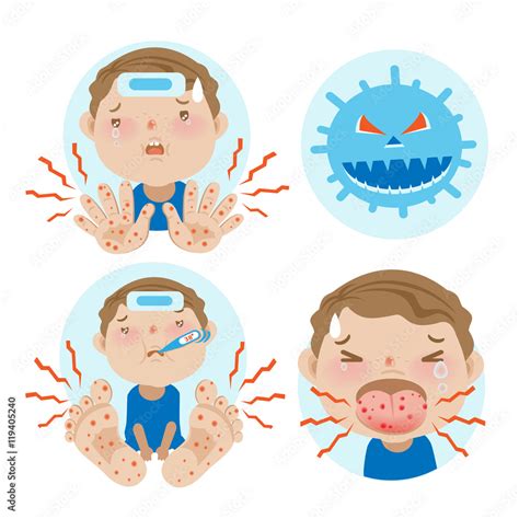 Hfmd Children Infected Hand Foot And Mouth Diseasecartoon Vector