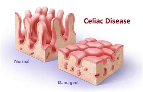 300 Facts You Didnt Know About Celiac Disease