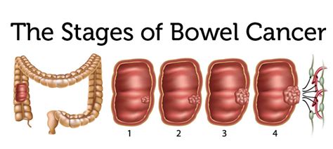 What Are The Signs Of Advanced Bowel Cancer Amudu Colorectal Cancer