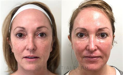 Co2 Laser Before And After Photos Patient 3 Natick Ma Essential Dermatology