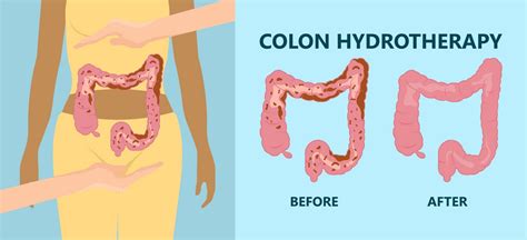 Colon Hydro Therapie Naturheilpraxis Alexandra Welzel