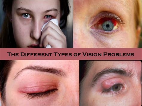 Common Vision Problems In Kids And Adults Explained Ppt