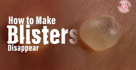 4 Sure Ways To Make Blisters Disappear Beaucrest