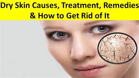 Dry Skin Causes Treatment Remedies And How To Get Rid Of It Youtube