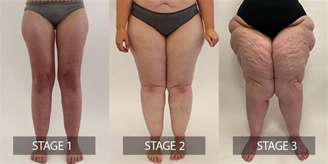 Different Stages And Types Of Lipedema Lipoclinic