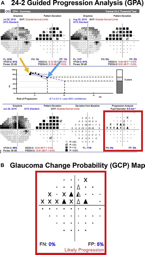 The 24 2 Visual Field Guided Progression Analysis Can Miss The Progression Of Glaucomatous