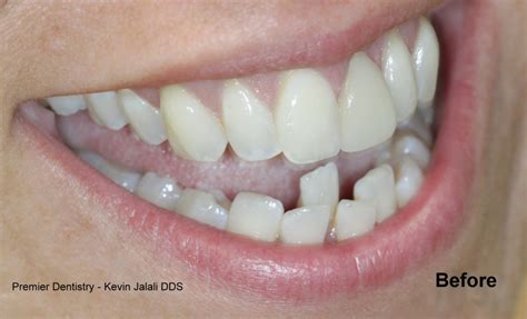 When it comes to cosmetic dentistry simi valley residents trust the caring and multilingual professionals at dental center of simi valley for all of their dental needs. Smile Gallery | Before After Photos | Dental Treatment Photos