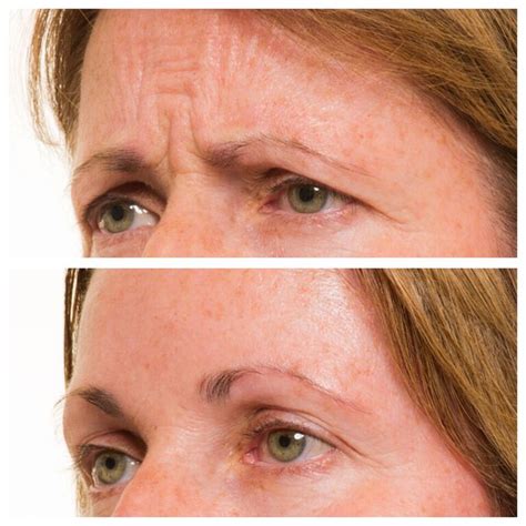 Anti Wrinkle Injections Complete Skin Solutions Rockhampton
