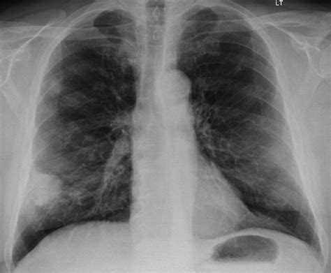 Figure 1 From A Hidden Lung Cancer In A Patient With Granulomatosis