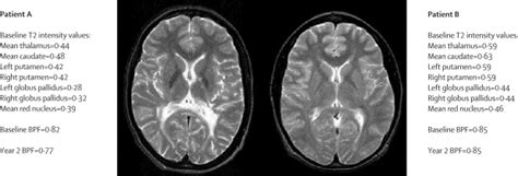 The Measurement And Clinical Relevance Of Brain Atrophy In Multiple