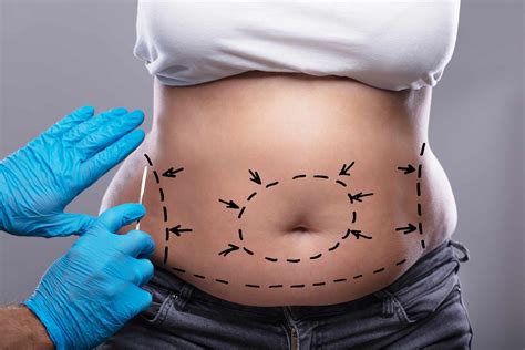 Tummy Tuck Recovery Tips For Healing As Quickly As Possible