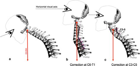 Effect Of Location Of Cervical And Cervicothoracic Osteotomies On
