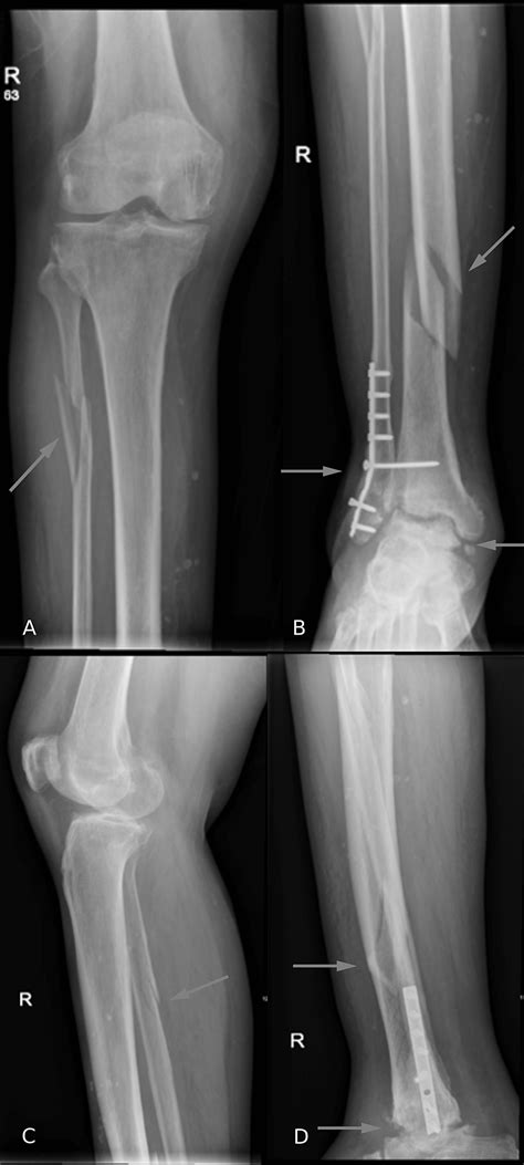 Simultaneous Surgical Management Of Acute Tibial Shaft Fracture And