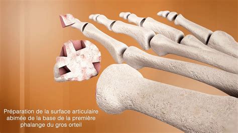 L Arthrod Se Du Gros Orteil Chirurgie Du Pied Clinique Du Parc Lyon Youtube