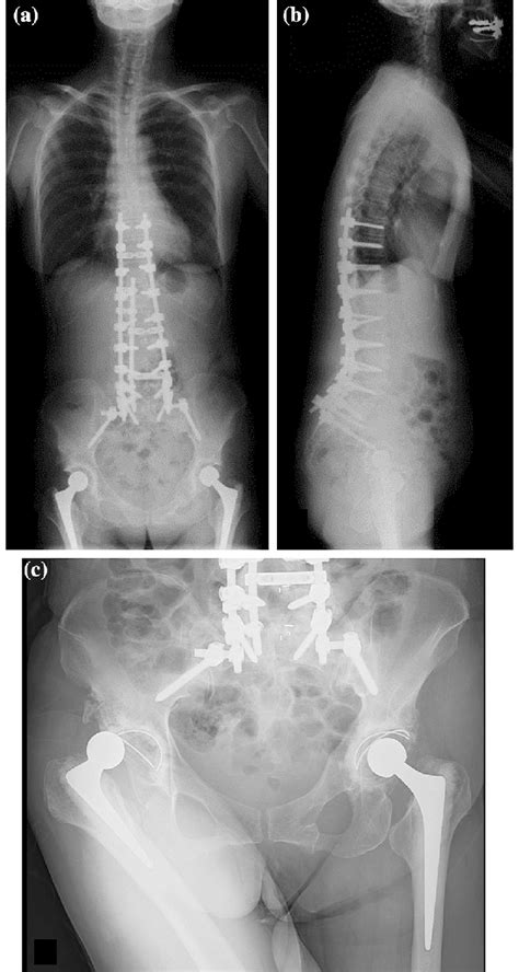 Standing Whole Spine Radiographs A B After Spinal Corrective Fusion
