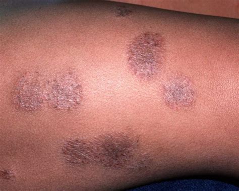 What Causes Eczema And How To Treat It Pulse Nigeria