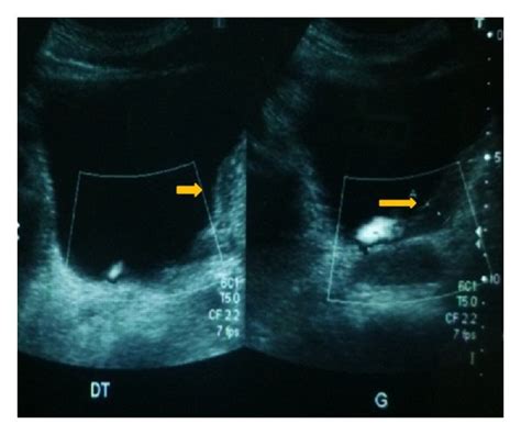 Ultrasound A And Ct Scan B Showing The Gallbladder Was Retracted
