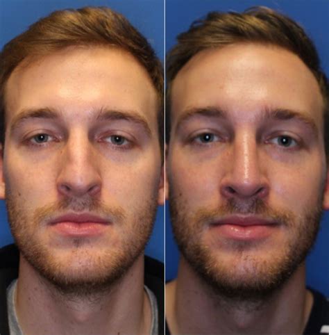 Nose Surgery Before And After Photos Patient 226 San Francisco Ca Kaiser