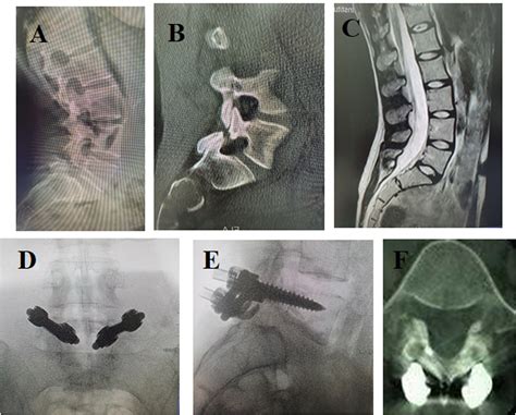 Pars Interarticularis Repair Using Pedicle Screws And Laminar Hooks