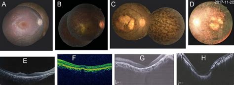 Fundus And Oct Images Of Each Fundus Type A The Macular Structure Is