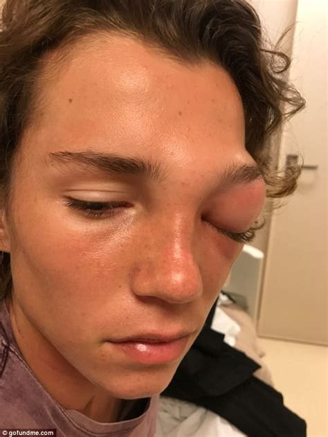 Teen Loses Left Eye Sight After Sinus Infection On Cruise Daily Mail