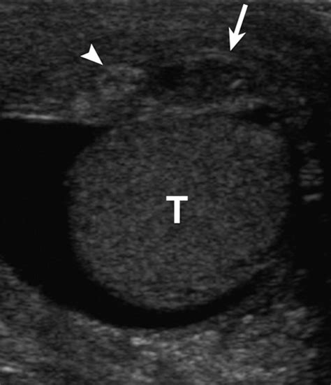 Role Of Us In Testicular And Scrotal Trauma Radiographics