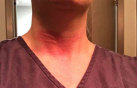 Red Swelling And Hives On The Neck Urticaria Writing Pictures Skin