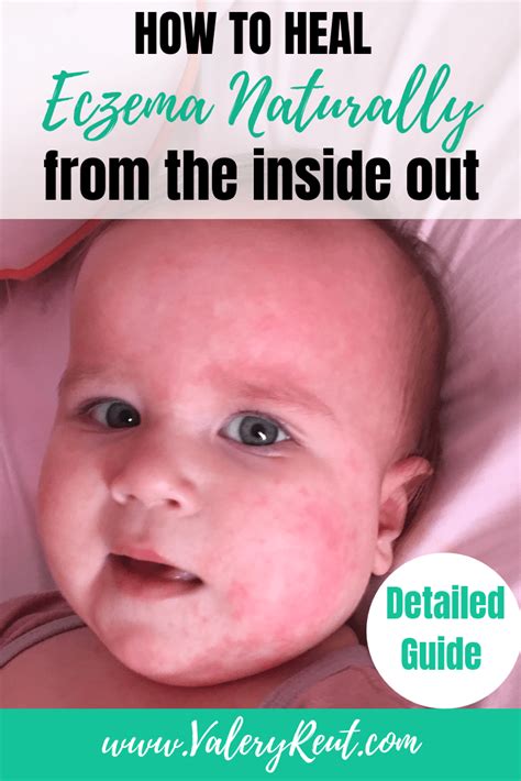 How To Heal Eczema Naturally From The Inside Out Eczema Treatment