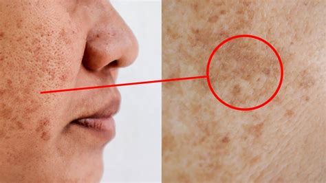 Science Explains The Signs Of Melasma And Why It Happens
