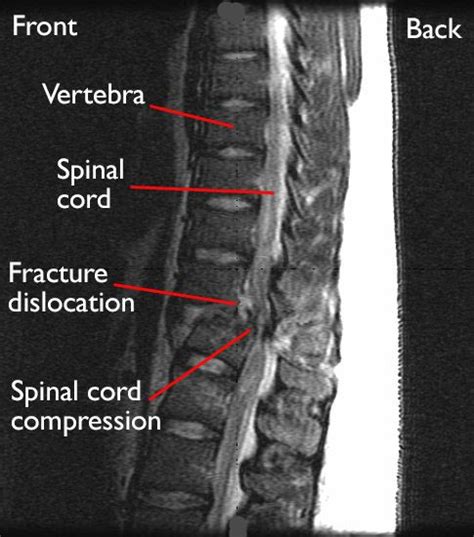 Fractures Of The Thoracic And Lumbar Spine Orthoinfo Aaos