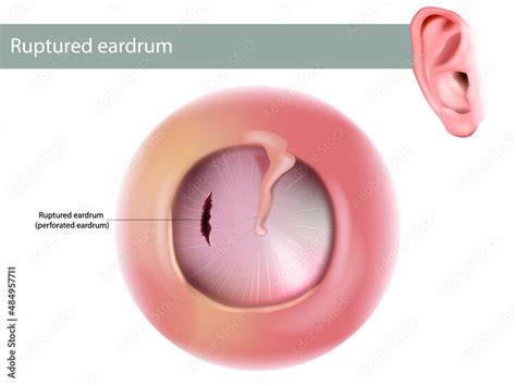 Ruptured Eardrum Or Perforated Eardrum Tympanic Membrane Perforation