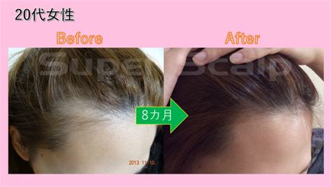 女性 M字 薄毛=>女子旅 温泉 エステ 九州 ~ 新しい壁紙日本HD