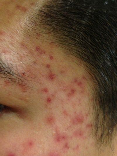 I Cant Tell How Bad My Acne Scarring Is Photo Doctor Answers Tips