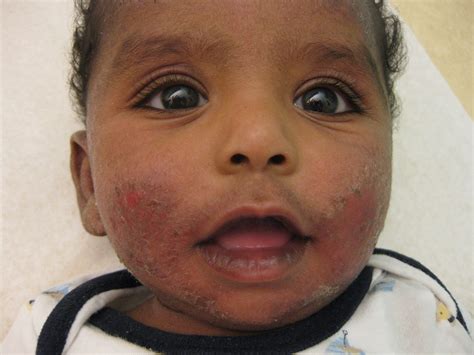 Severe Eczema On Face