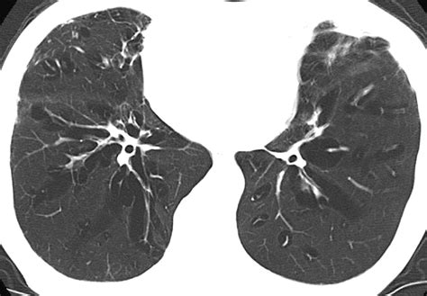 Persistent Diffuse Pulmonary Interstitial Emphysema Mimicking Pulmonary
