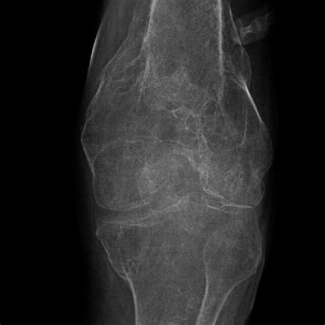 Left Knee X Ray Oblique Externally Rotated Diffuse Bony