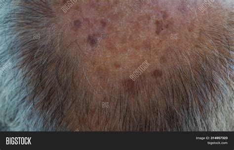 Front Bald Head Old Image And Photo Free Trial Bigstock