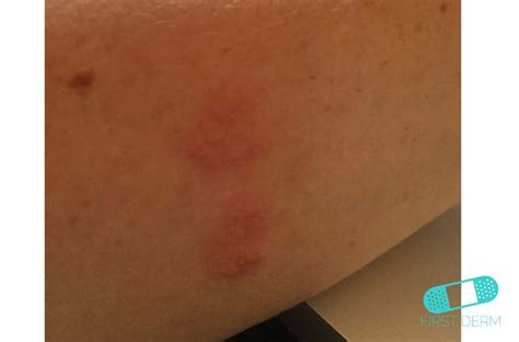 Nummular Eczema Discoid Dermatitis