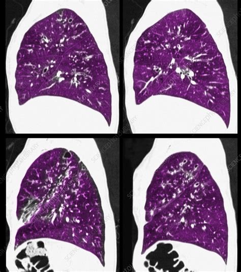 Cystic Fibrosis Of The Lungs Ct Scan Stock Image C