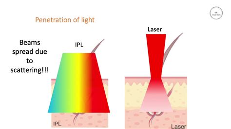 Difference Between Laser And Ipl Hair Removal Youtube