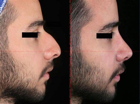 Before And After Nose Job Male Pic Rhinoplasty Cost Pics Reviews Qanda