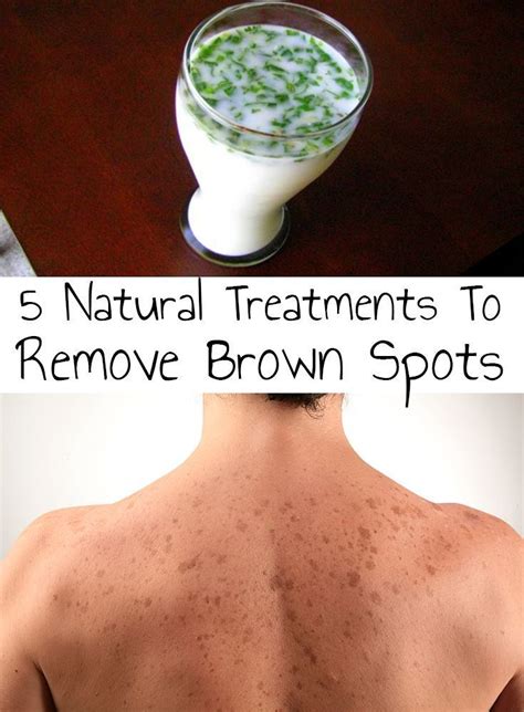 Brown Spots Ussualy Appear On Sun Exposed Areas Of Skin Such As The