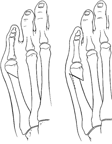Figure 21 From Fifth Metatarsal Osteotomies Semantic Scholar