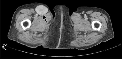 Computed Tomography Revealed An Enlarged Lymph Node Arrow In The