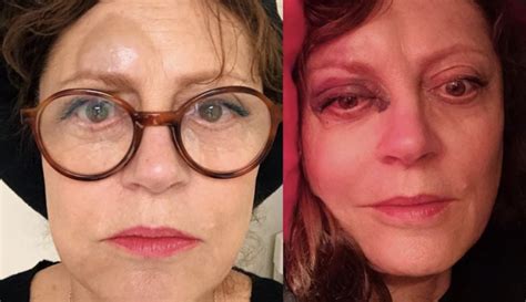 Susan Sarandon Posts Pictures After Fall Fractured Nose And Concussion