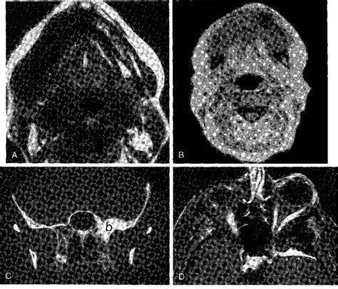 Figure 17 From Head And Neck Lesions Radiologic Pathologic